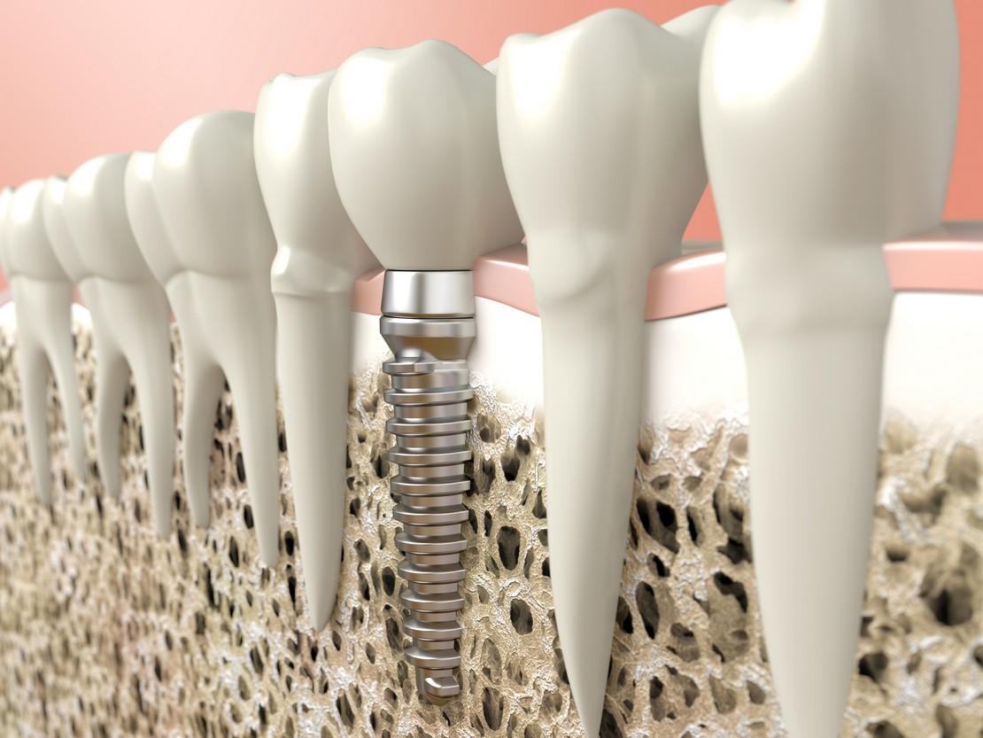 Zahnimplantate in Ungarn - Denis & Focus Dental Centrum